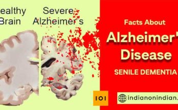 Alzheimer’s Disease