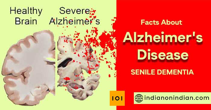 Alzheimer’s Disease