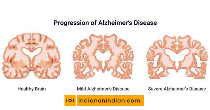 How Brain changes in Alzheimer’s disease?